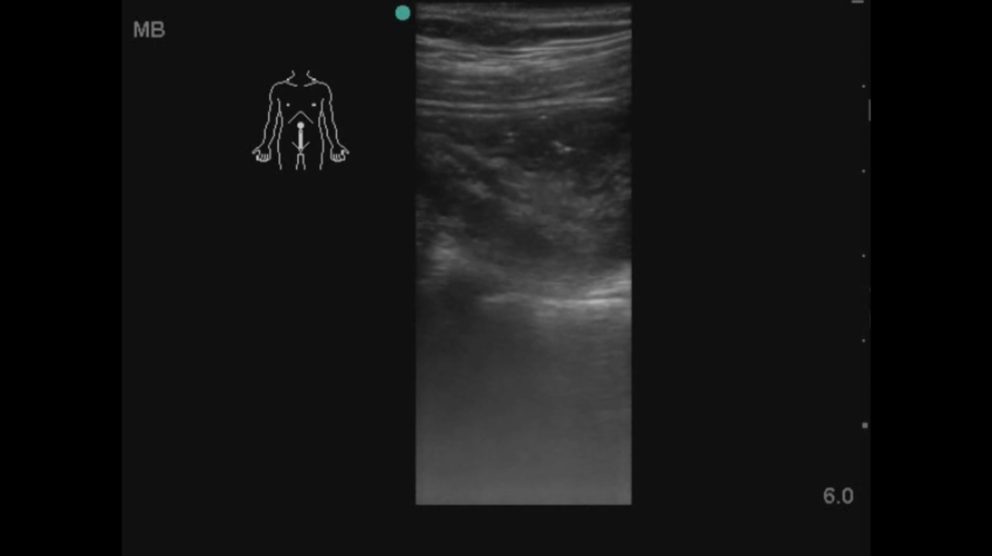 How accurate is point-of-care-ultrasound (POCUS) at diagnosing acute appendicitis?